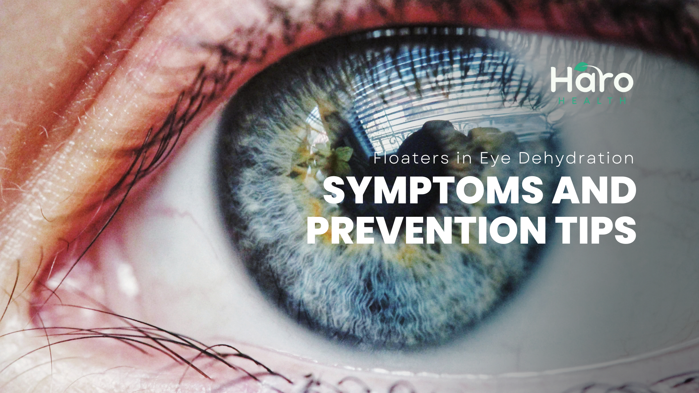 Hydration and eye floaters: keeping the distinction clear